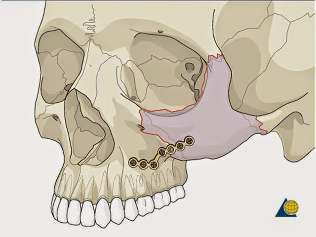 從顴骨骨折的治療觀點談顴骨削骨手術,陳怡傑正顎